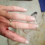 mordedura gato